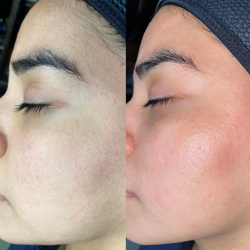 my-experience-dermaplaning-before-after-photos-beauty-treatments